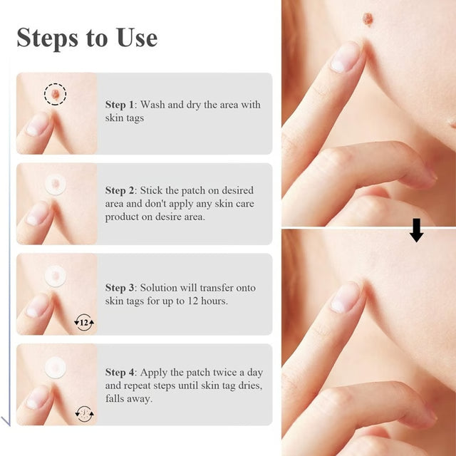 Skin Mole Removal Patch for Easy At Home Skin Tag and Mole Care
