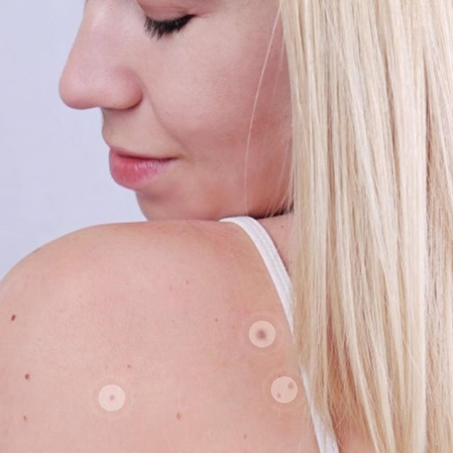 Skin Mole Removal Patch for Easy At Home Skin Tag and Mole Care
